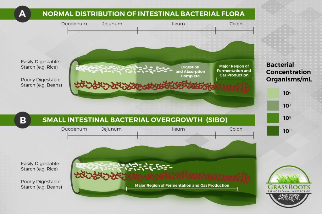 SIBO in the Small Intestine vs Not