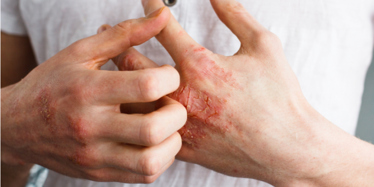 6 Root Causes of Eczema & How to Treat it Naturally